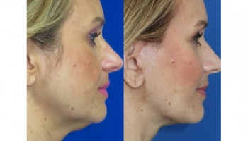 Lifting facial – spune adio ridurilor profunde