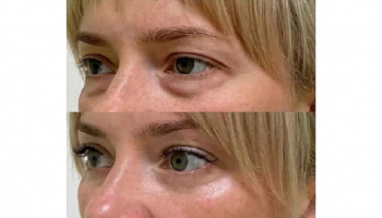 Blefaroplastie inferioară – înlătură pungile de sub ochi