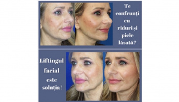 Lifting facial pentru un profil facial tânăr